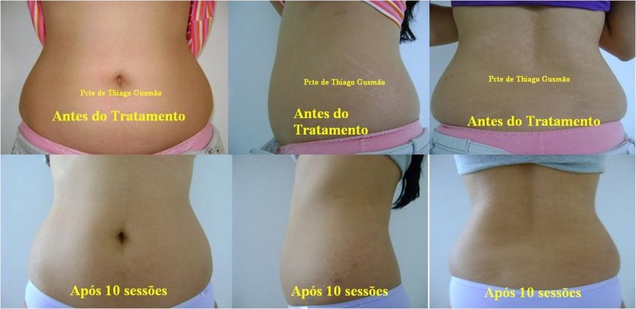 Antes e depois — resultado abdominal com Carboxiterapia, frontal e costas, após 10 sessões