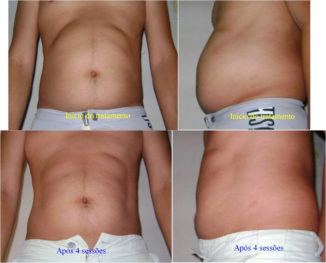 Antes e depois — resultado abdominal com Carboxiterapia, frontal e lateral, após 4 sessões