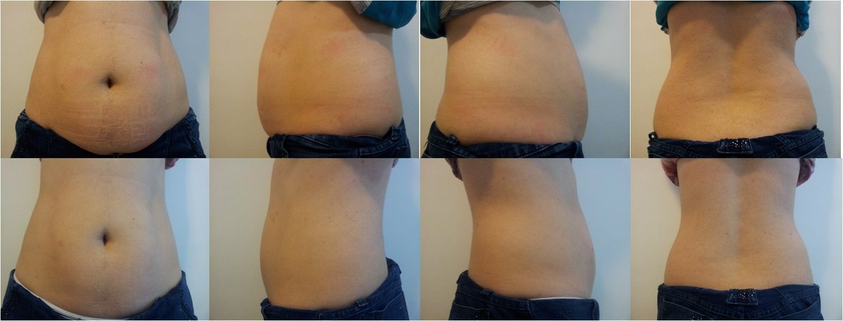 Antes e depois — resultado abdominal com Carboxiterapia, múltiplas vistas