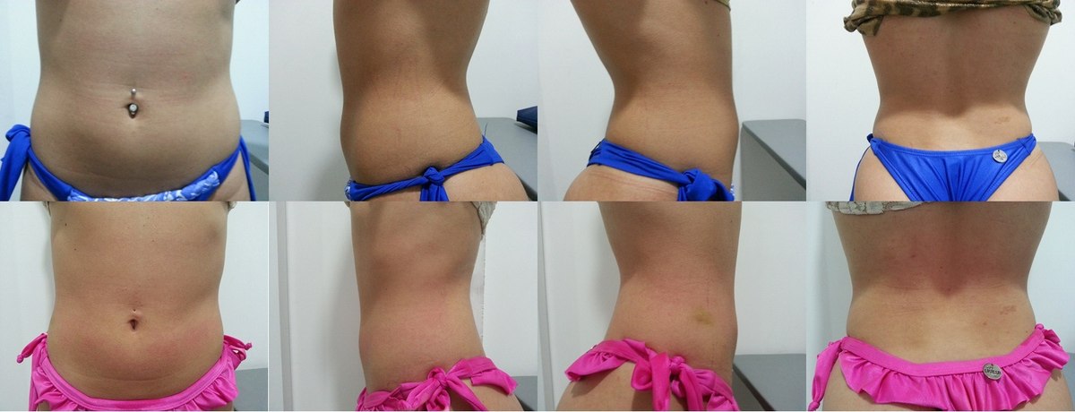 Antes e depois — resultado abdominal com Carboxiterapia, múltiplas vistas