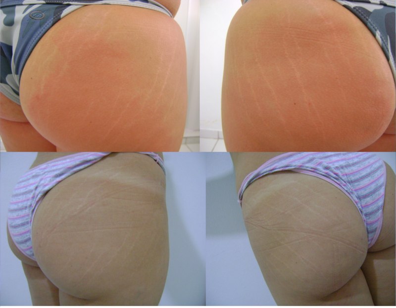Antes e depois — resultado nos glúteos com Carboxiterapia, melhora da textura da pele
