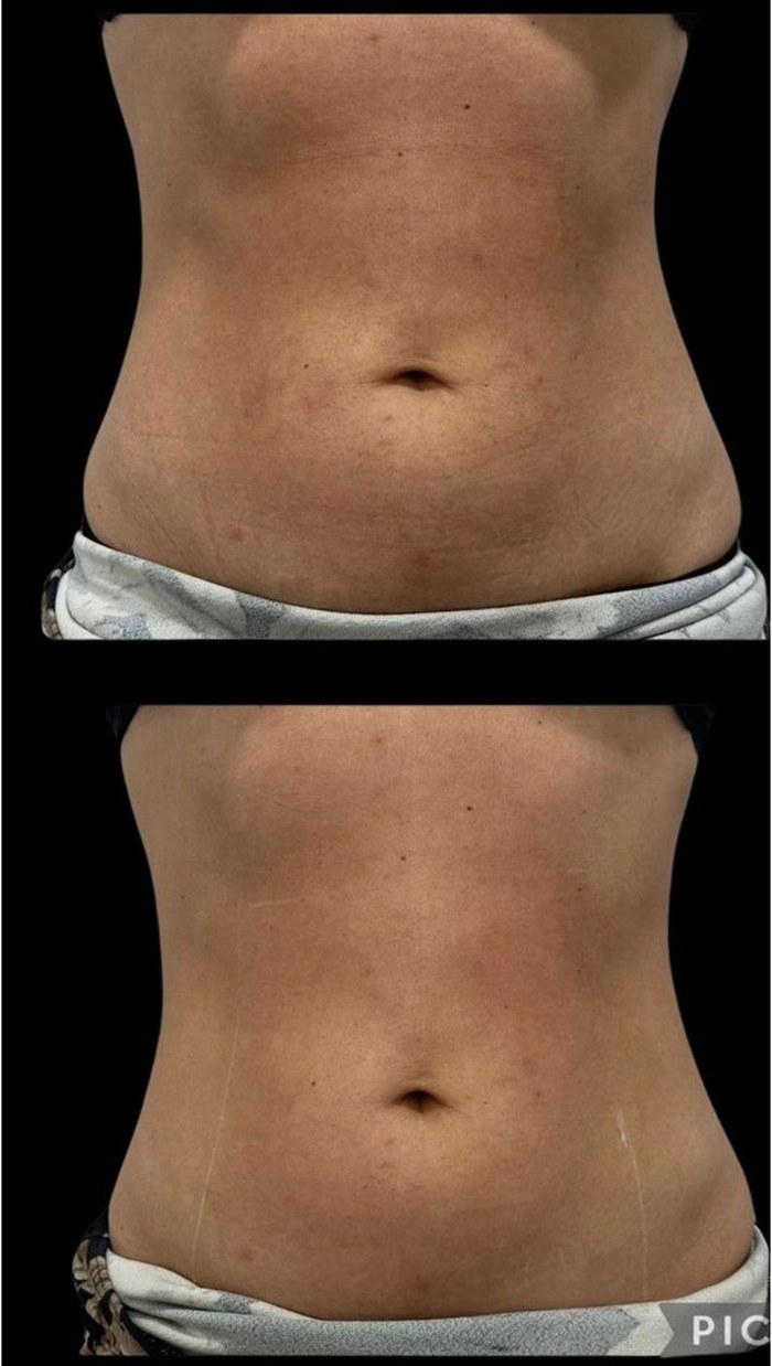 Antes e depois — resultado corporal com HIPRO no abdômen