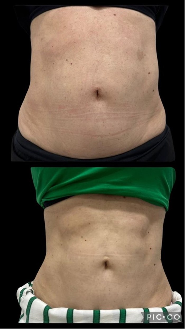 Antes e depois — resultado corporal com HIPRO no abdômen