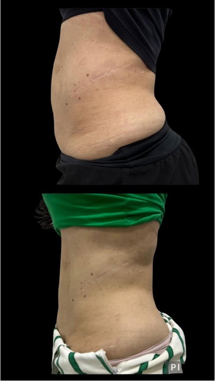 Antes e depois — resultado corporal com HIPRO no abdômen, vista lateral