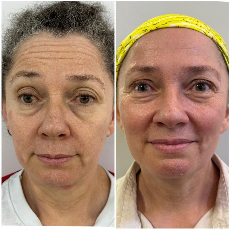 Antes e depois — resultado facial com HIPRO, região dos olhos e testa