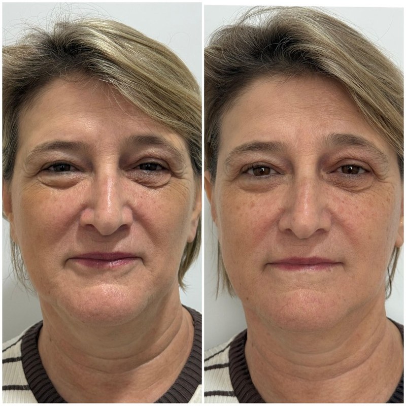 Antes e depois — resultado facial com HIPRO, contorno e firmeza