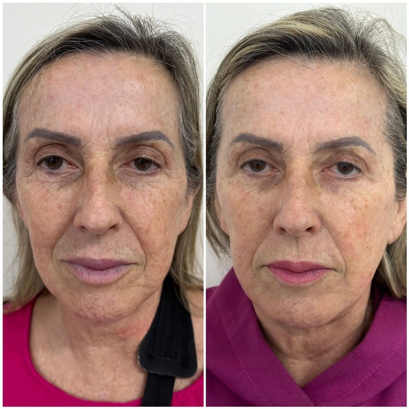 Antes e depois — resultado facial com HIPRO, firmeza e contorno
