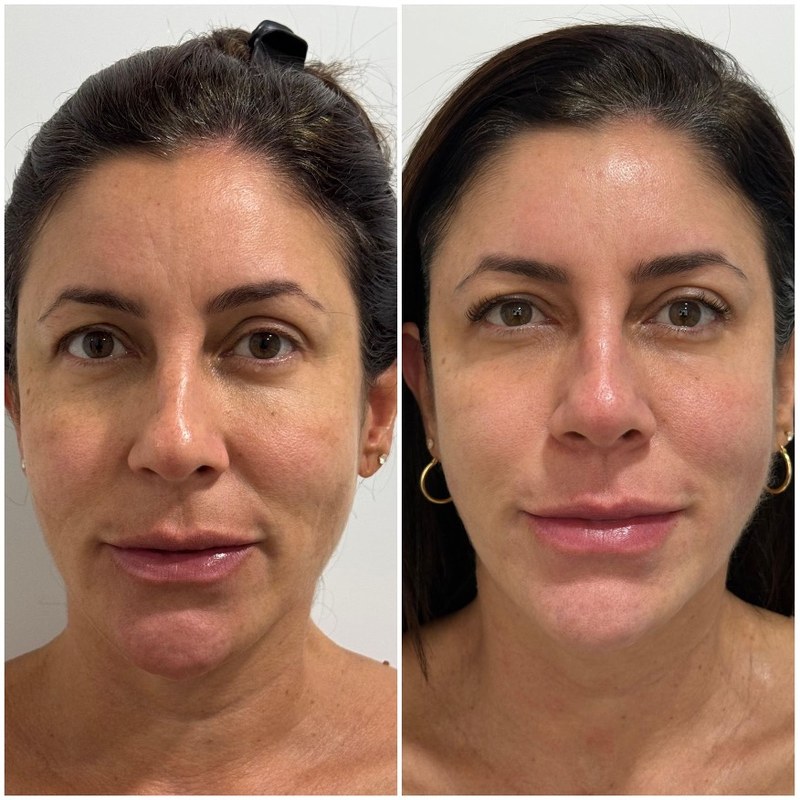 Antes e depois — resultado facial com HIPRO, firmeza e viço da pele