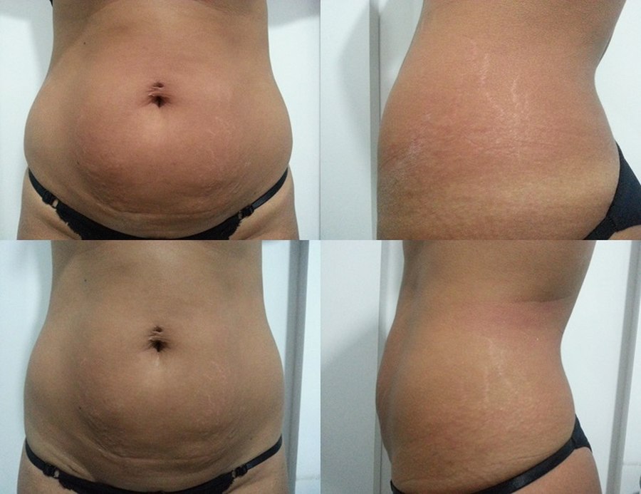 Antes e depois — resultado abdominal com Iconyc, vista frontal e lateral