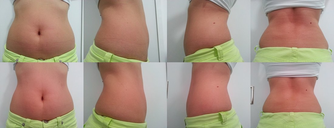 Antes e depois — resultado abdominal com Iconyc, vista frontal e lateral
