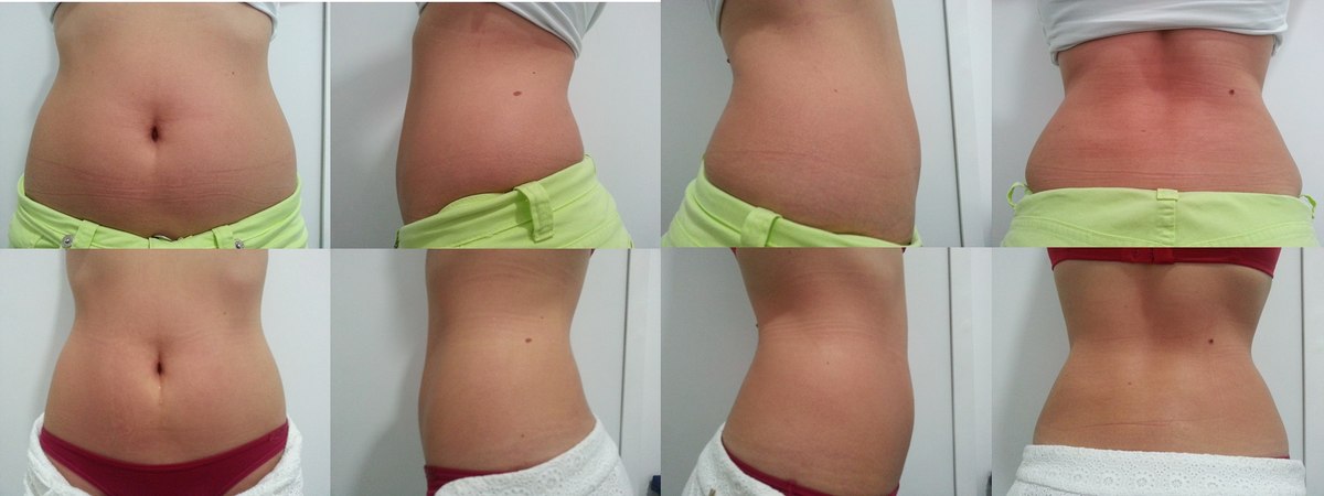 Antes e depois — resultado abdominal com Iconyc, múltiplas vistas