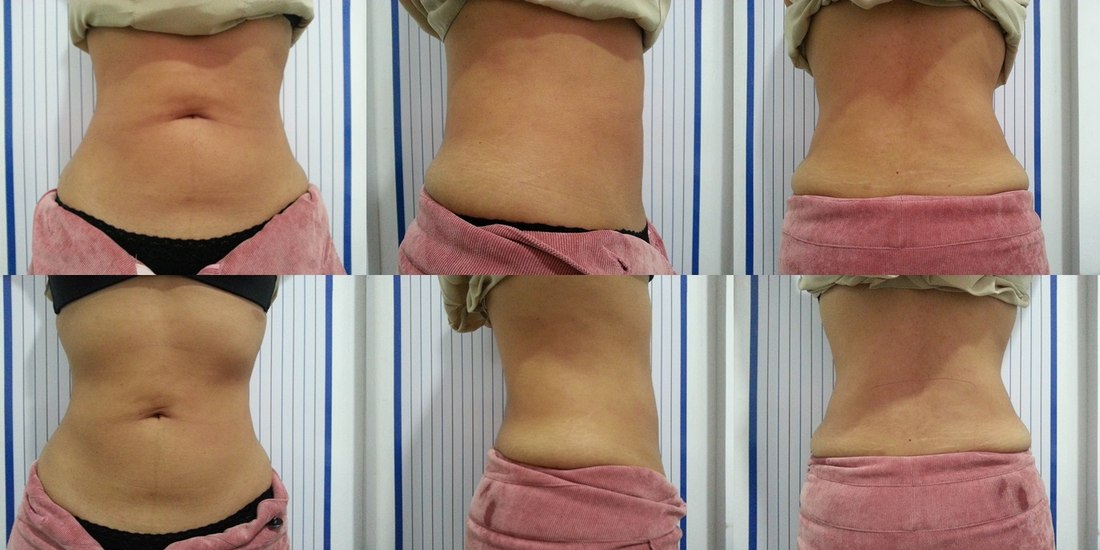 Antes e depois — resultado abdominal com Iconyc, vista frontal e lateral