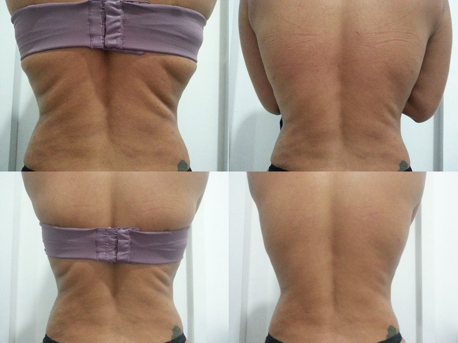 Antes e depois — resultado nas costas com Iconyc, melhora da flacidez