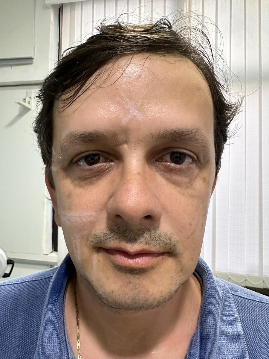 Resultado comparativo — HIPRO aplicado apenas no lado esquerdo do rosto