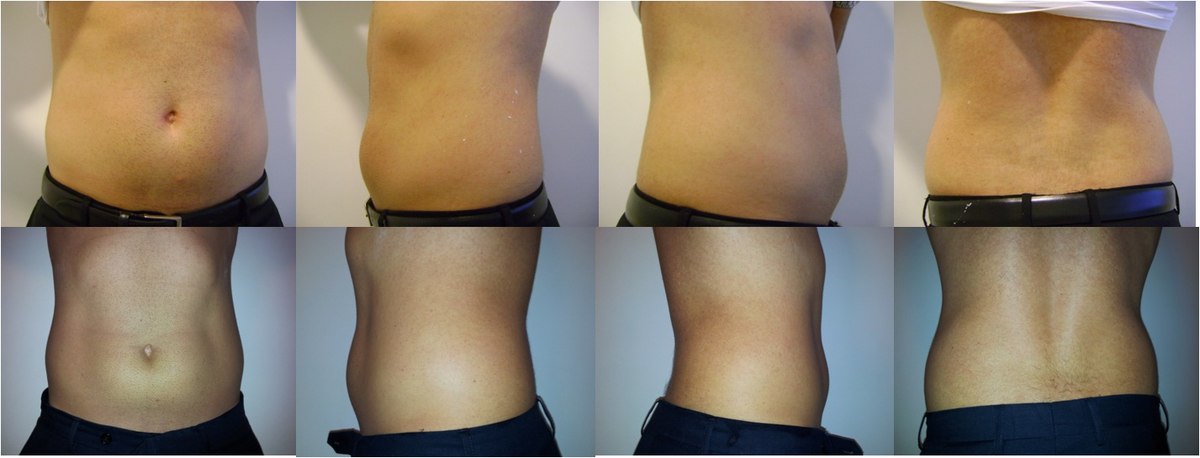 Antes e depois — resultado abdominal com Ultranature, múltiplas vistas