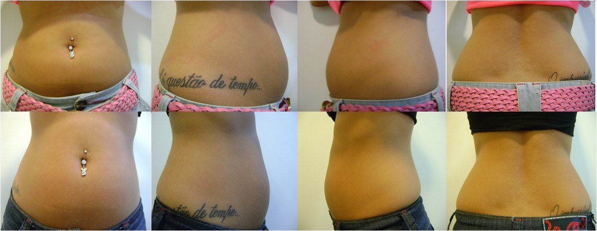 Antes e depois — resultado abdominal com Ultranature, múltiplas vistas