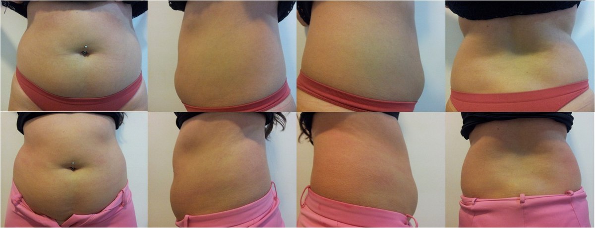 Antes e depois — resultado abdominal com Ultranature, múltiplas vistas