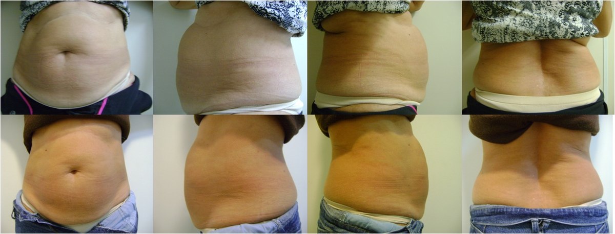 Antes e depois — resultado abdominal com Ultranature, múltiplas vistas